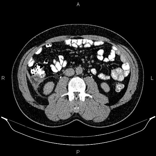 Acute appendicitis (Radiopaedia 84780-100240 Axial C+ delayed 52).jpg