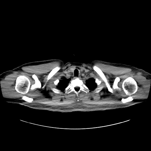 Acute appendicitis and COVID 19 pneumonia (Radiopaedia 76604-88380 Axial non-contrast 6).jpg