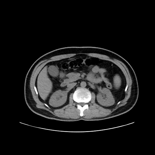 Acute appendicitis and COVID 19 pneumonia (Radiopaedia 76604-88380 Axial non-contrast 67).jpg