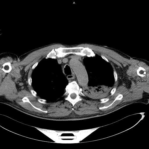 Acute aspiration pneumonitis (Radiopaedia 55642-62166 Axial liver window 19).jpg