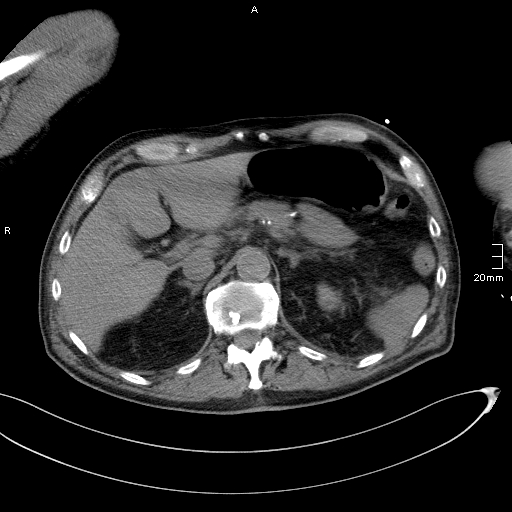 File:Acute aspiration pneumonitis (Radiopaedia 55642-62166 Axial liver window 62).jpg
