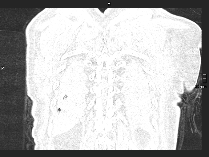 Acute aspiration pneumonitis (Radiopaedia 55642-62166 Coronal lung window 94).jpg