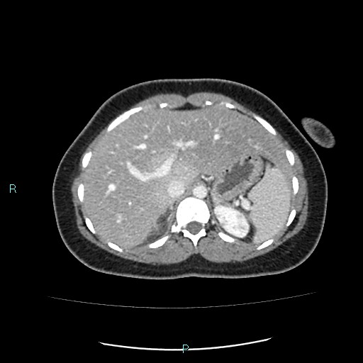 Acute bilateral pyelonephritis (Radiopaedia 37146-38881 Axial C+ portal venous phase 24).jpg