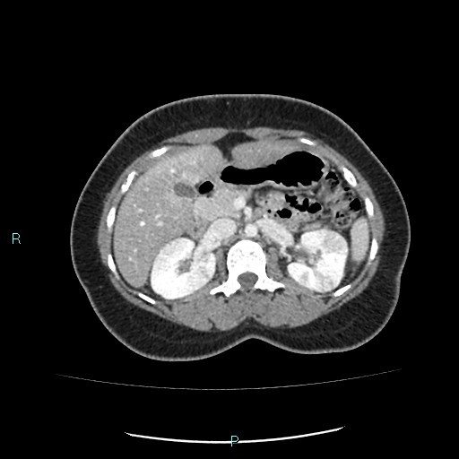 Acute bilateral pyelonephritis (Radiopaedia 37146-38881 Axial C+ portal venous phase 39).jpg