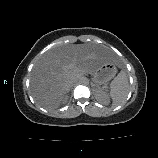 Acute bilateral pyelonephritis (Radiopaedia 37146-38881 Axial non-contrast 26).jpg