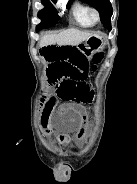 Acute bowel ischemia (Radiopaedia 87695-104114 Coronal C+ portal venous phase 101).jpg