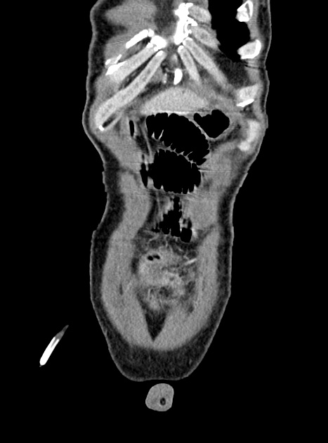 Acute bowel ischemia (Radiopaedia 87695-104114 Coronal C+ portal venous phase 80).jpg
