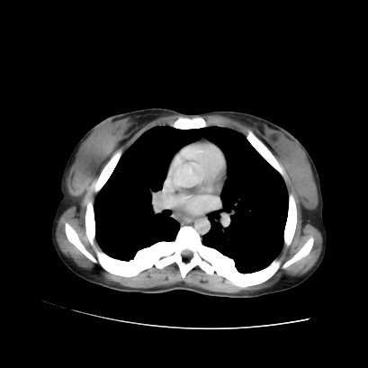 Acute calculous cholecystitis in patient with osteopetrosis (Radiopaedia 77871-90159 Axial C+ portal venous phase 3).jpg