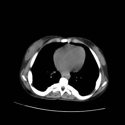 File:Acute calculous cholecystitis in patient with osteopetrosis (Radiopaedia 77871-90159 Axial non-contrast 8).jpg