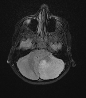 File:Acute cerebellar ataxia (Radiopaedia 61487-69446 Axial FLAIR 4).jpg