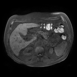Acute cholecystitis complicated by pylephlebitis (Radiopaedia 65782-74915 Axial T1 fat sat 49).jpg