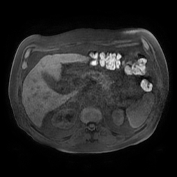 Acute cholecystitis complicated by pylephlebitis (Radiopaedia 65782-74915 Axial T1 fat sat 51).jpg