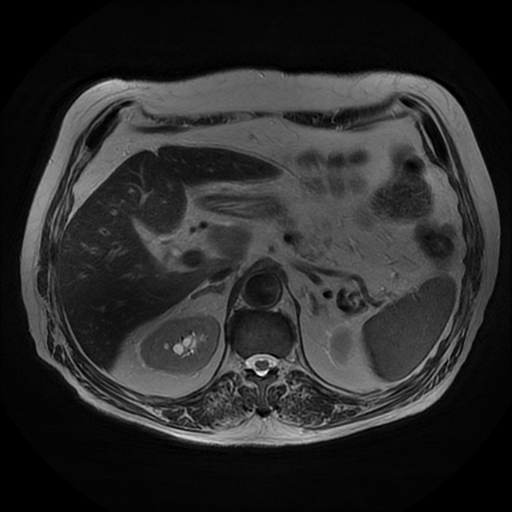 File:Acute cholecystitis complicated by pylephlebitis (Radiopaedia 65782-74915 Axial T2 16).jpg