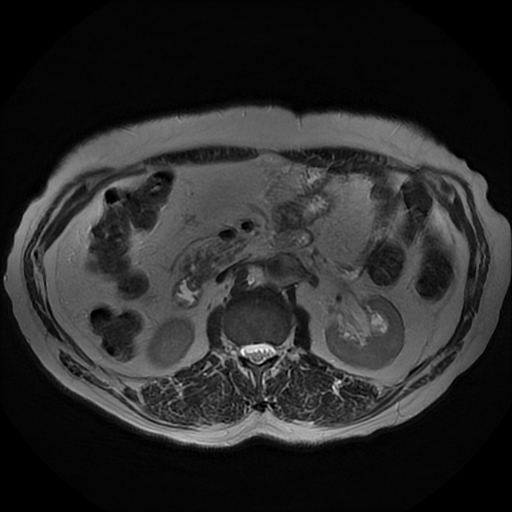 File:Acute cholecystitis complicated by pylephlebitis (Radiopaedia 65782-74915 Axial T2 26).jpg