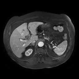 Acute cholecystitis complicated by pylephlebitis (Radiopaedia 65782-74915 Axial arterioportal phase T1 C+ fat sat 45).jpg