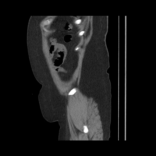 File:Acute cholecystitis with tensile fundus sign (Radiopaedia 71394-81723 Sagittal non-contrast 145).jpg