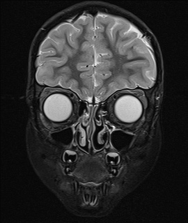 File:Acute disseminating encephalomyelitis with bilateral optic neuritis (Radiopaedia 79676-92886 Coronal STIR 5).jpg