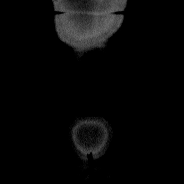 Acute diverticulitis (Radiopaedia 34183-35442 Coronal C+ portal venous phase 79).jpg