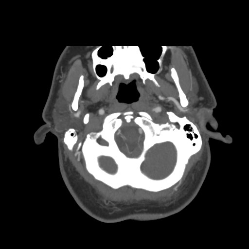 File:Acute internal carotid artery dissection (Radiopaedia 53541-59630 D 8).jpg