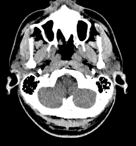 Acute ischemic stroke - posterior circulation territory (Radiopaedia 77670-89881 non-contrast 7).jpg