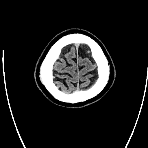 Acute left middle cerebral artery territory ischemic stroke (Radiopaedia 35688-37223 Axial non-contrast 80).png