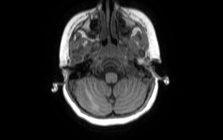 File:Acute necrotizing encephalitis of childhood (Radiopaedia 67356-76737 Axial T1 81).jpg