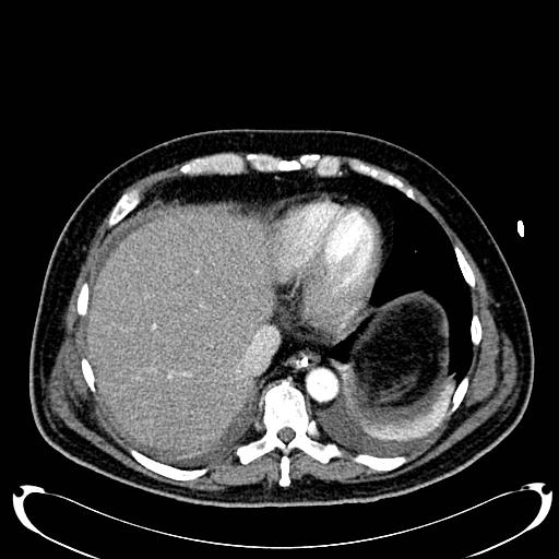 Acute pancreatic necrosis (Radiopaedia 13560-18500 Axial C+ portal venous phase 23).jpg