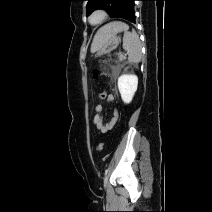 Acute pancreatitis (Radiopaedia 69236-79012 Sagittal C+ portal venous phase 32).jpg