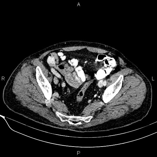 Acute pancreatitis (Radiopaedia 85146-100701 Axial C+ portal venous phase 55).jpg
