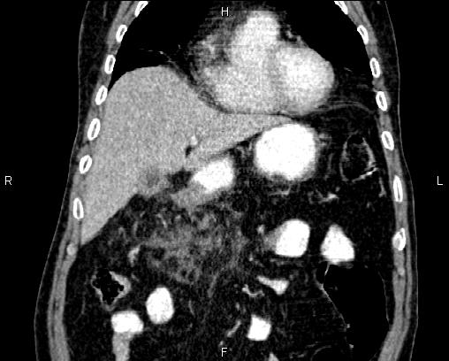 Acute pancreatitis (Radiopaedia 85146-100701 Coronal C+ portal venous phase 20).jpg