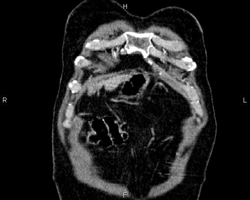 Acute pancreatitis (Radiopaedia 85146-100701 Coronal C+ portal venous phase 3).jpg