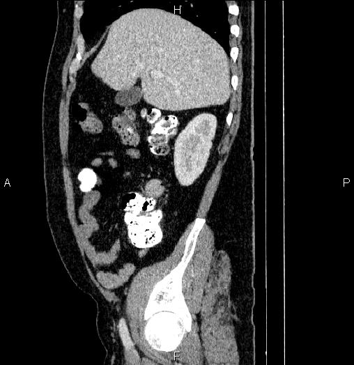 Acute pancreatitis (Radiopaedia 85390-101010 Sagittal C+ portal venous phase 23).jpg