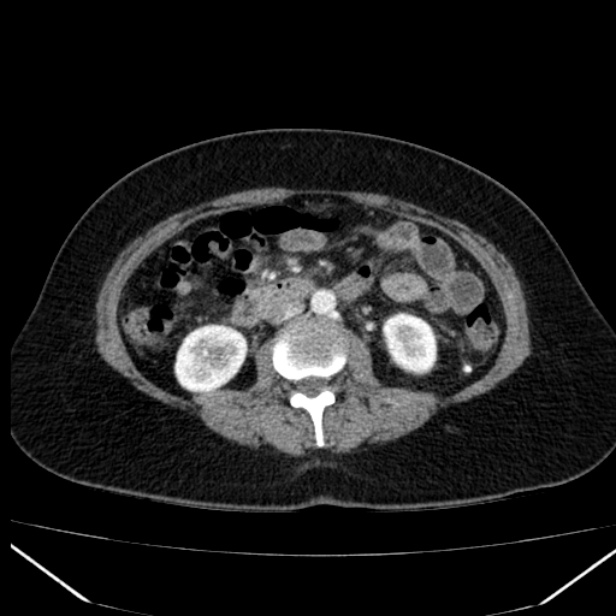 Acute pancreatitis - Balthazar C (Radiopaedia 26569-26714 Axial C+ arterial phase 45).jpg