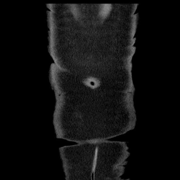 Acute pancreatitis - Balthazar C (Radiopaedia 26569-26714 Coronal C+ portal venous phase 71).jpg
