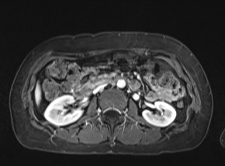 Acute pancreatitis - Balthazar E - post ERCP (Radiopaedia 27562-27778 F 57).png