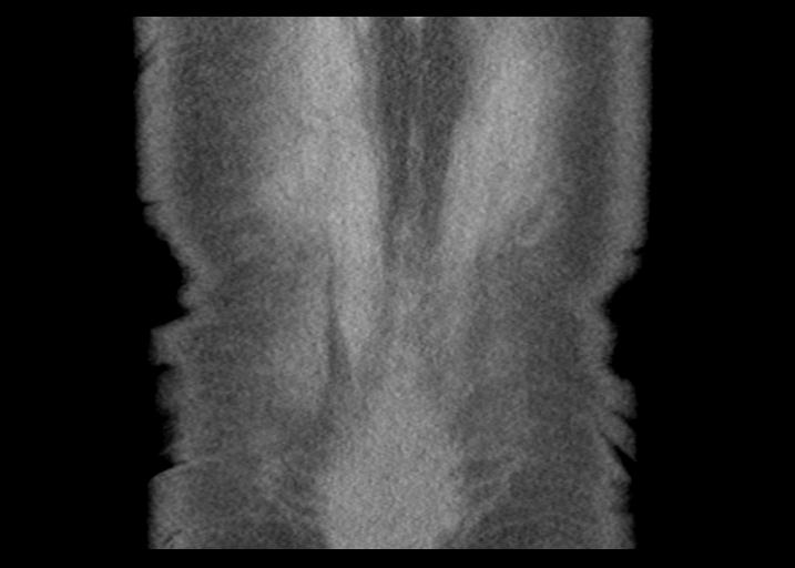 Acute pancreatitis and walled-off necrosis (Radiopaedia 29888-30403 Coronal C+ portal venous phase 54).jpg