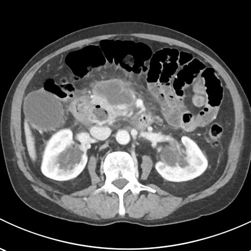 File:Acute pancreatitis and walled-off necrosis (Radiopaedia 29888-30404 Axial C+ portal venous phase 34).jpg