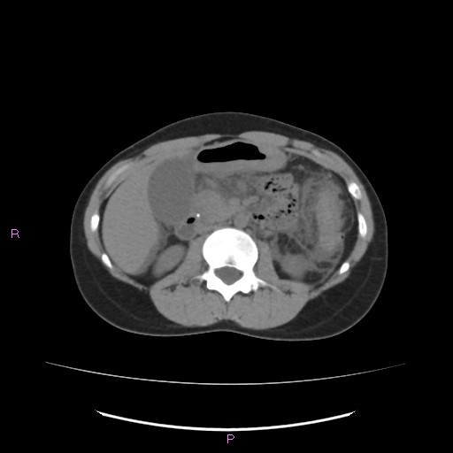File:Acute pancreatitis secondary to stone at minor papilla and pancreatic divisum (Radiopaedia 76570-88333 Axial non-contrast 32).jpg