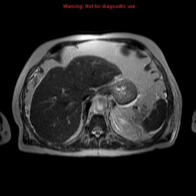 File:Acute pancreatitis with incidental pancreatic lipoma (Radiopaedia 10190-10732 Axial T2 20).jpg