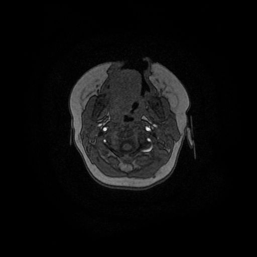 Acute phase of hemiconvulsion-hemiplegia epilepsy syndrome (Radiopaedia 29309-29745 Axial TOF angiography 168).jpg