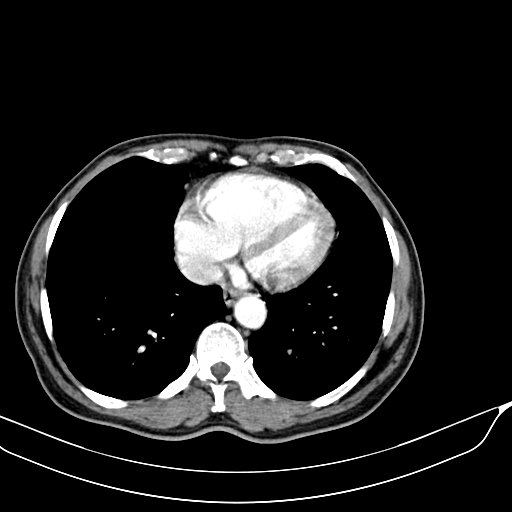 Acute pulmonary embolism (Radiopaedia 69510-79390 D 66).jpg