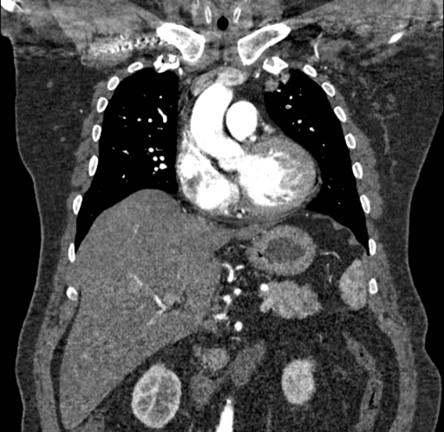 Acute pulmonary embolism with pulmonary infarcts (Radiopaedia 77688-89908 Coronal C+ CTPA 32).jpg