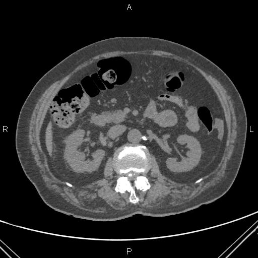 Acute renal artery occlusion (Radiopaedia 86586-102682 Axial non-contrast 31).jpg
