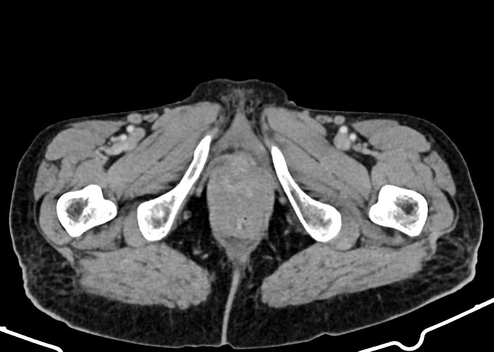 Acute small bowel (ileal) volvulus (Radiopaedia 71740-82139 Axial C+ portal venous phase 212).jpg