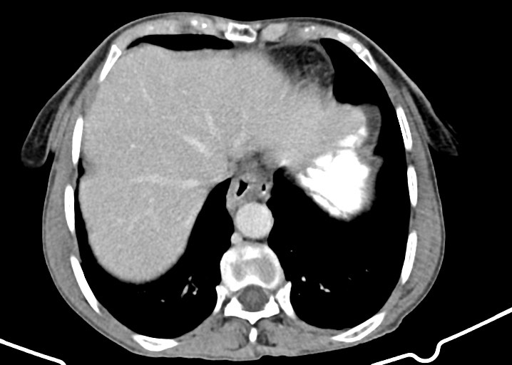 Acute small bowel (ileal) volvulus (Radiopaedia 71740-82139 Axial C+ portal venous phase 41).jpg