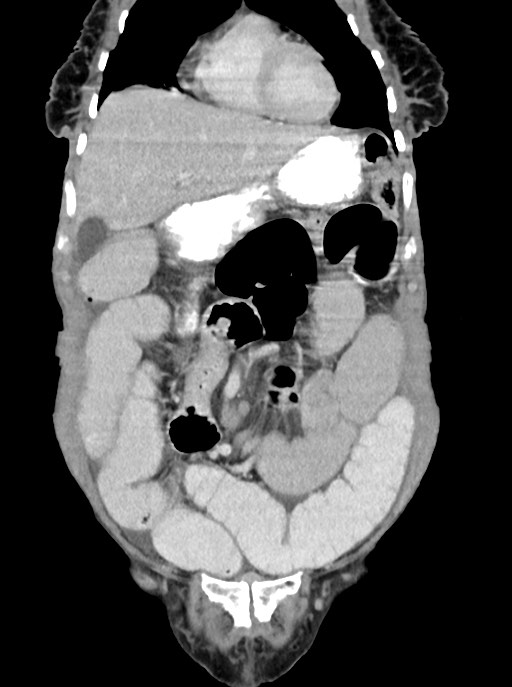 Acute small bowel (ileal) volvulus (Radiopaedia 71740-82139 Coronal C+ portal venous phase 33).jpg