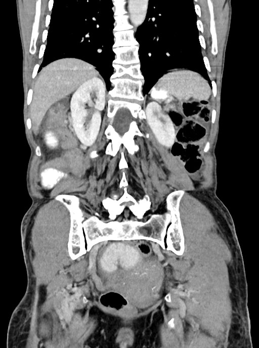 Acute small bowel (ileal) volvulus (Radiopaedia 71740-82139 Coronal C+ portal venous phase 83).jpg