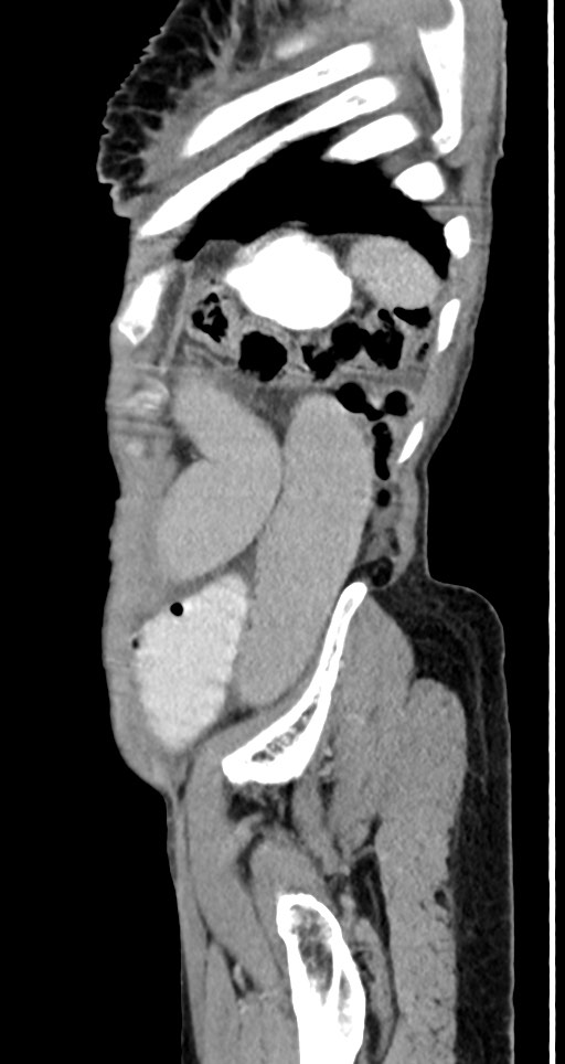 Acute small bowel (ileal) volvulus (Radiopaedia 71740-82139 Sagittal C+ portal venous phase 35).jpg