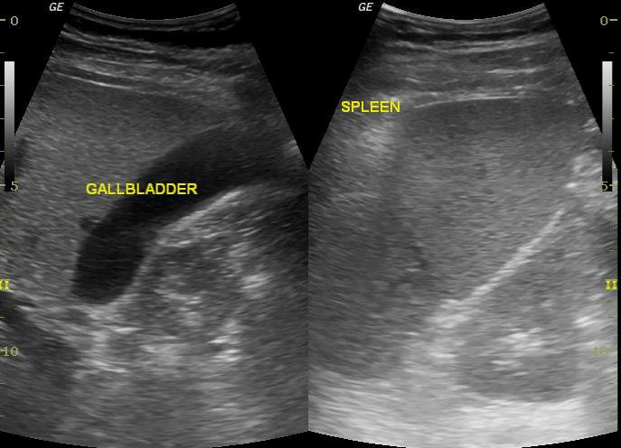 File:Acute superior mesenteric vein thrombosis (Radiopaedia 26696-26853 A 1).jpg