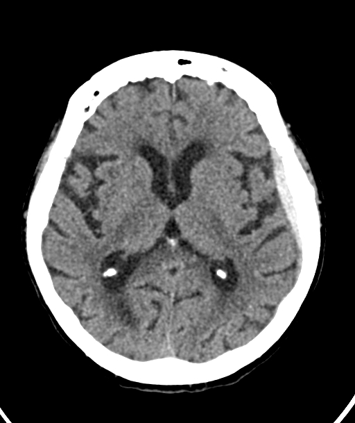 Acute traumatic subdural hematoma (Radiopaedia 82921-97257 Axial non-contrast 34).jpg